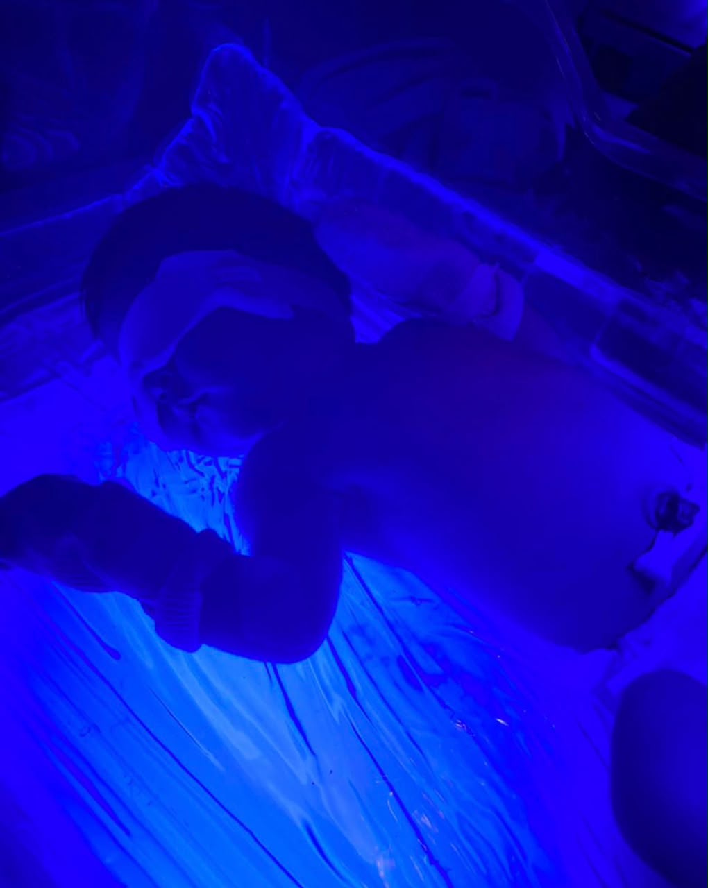 bebê tomando banho de luz de icterícia